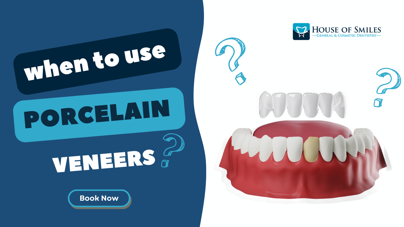 Read more about the article When To Use Porcelain Veneers in Royal Palm Beach.