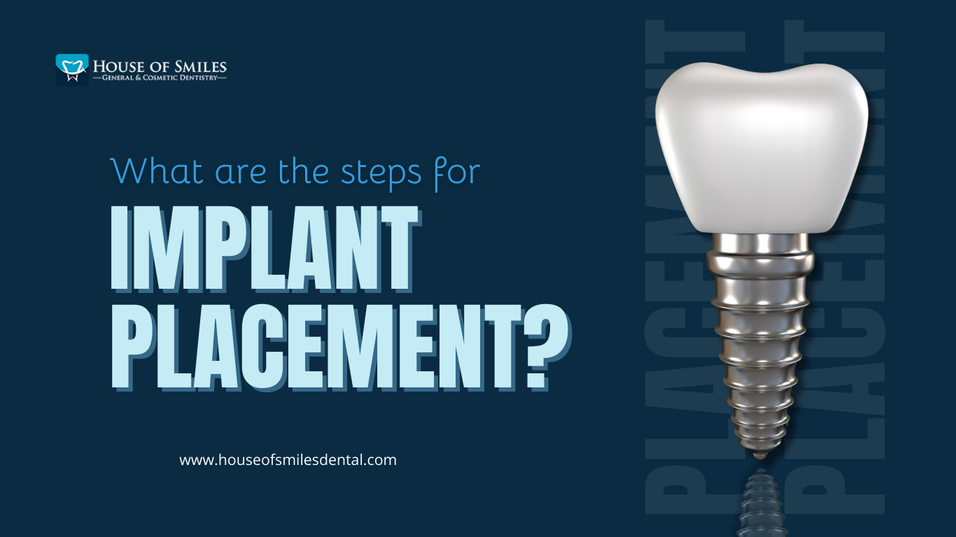 You are currently viewing Implant placement – Royal Palm Beach, FL