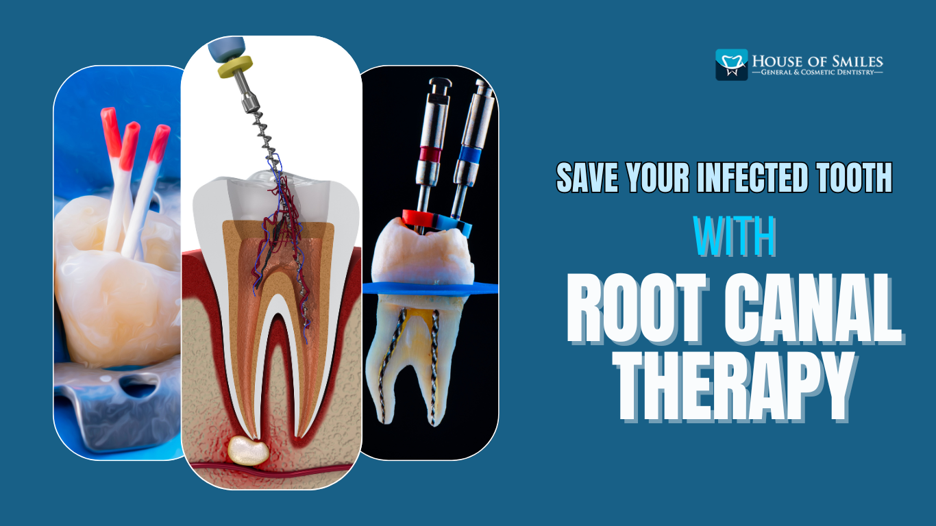 Read more about the article Root Canal in Royal Palm Beach, FL