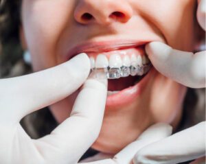 Aligner Fitting Adjustments