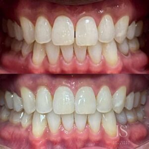 Invisalign Palm Beach Gardens