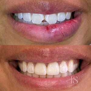 Invisalign in florida