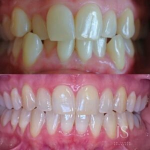 Best Invisalign Dentist in Wellington