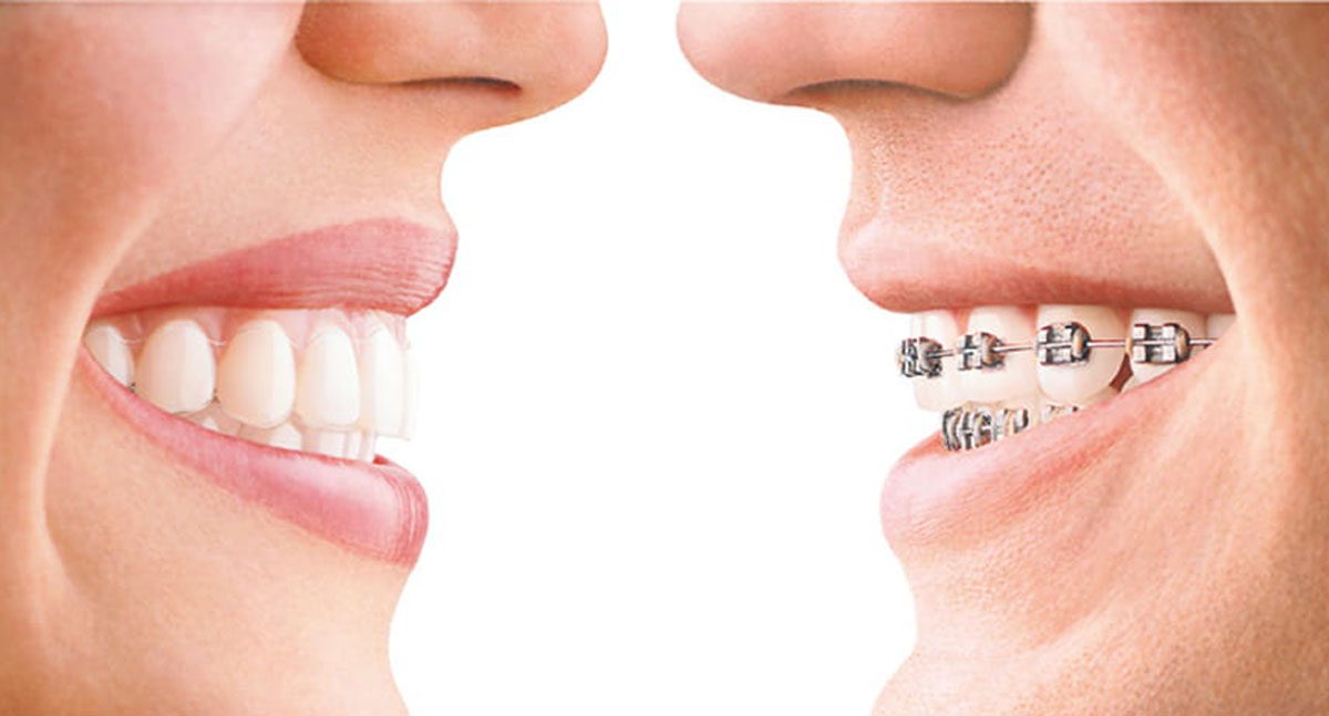 Invisalign vs. Traditional Braces: Which Is Right for You?
