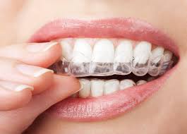 Invisalign Dentist in florida